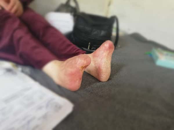 A woman is disable due to an old burn