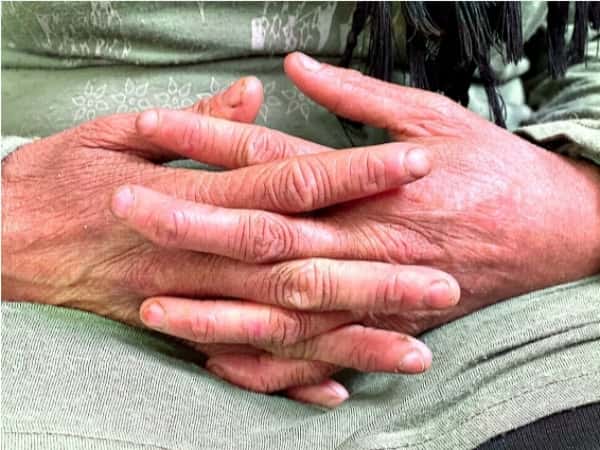 Helana suffers from a chronic condition