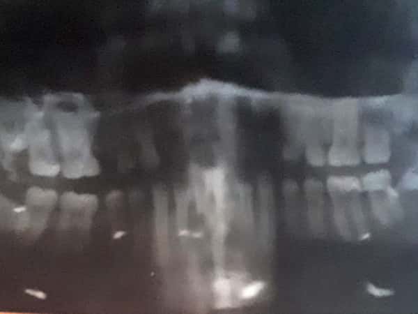 a child lost her teeth