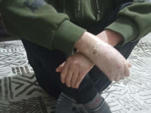 Abdul Rahman: Ein Kind, das an Pemphigus leidet