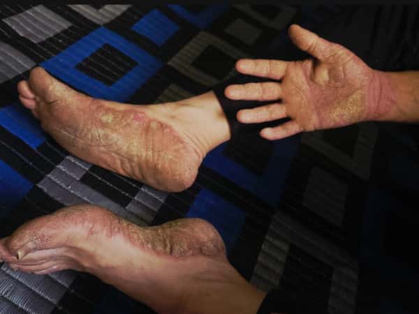 Psoriasis, Tourette’s, and Three Children Waiting for Support