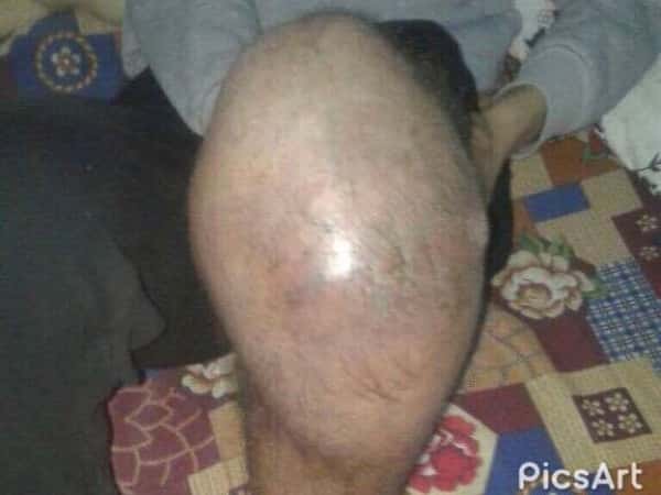 A young man suffering from cancer