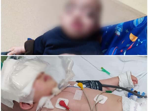 Mohammad suffers from skull deformation and respiratory occlusion