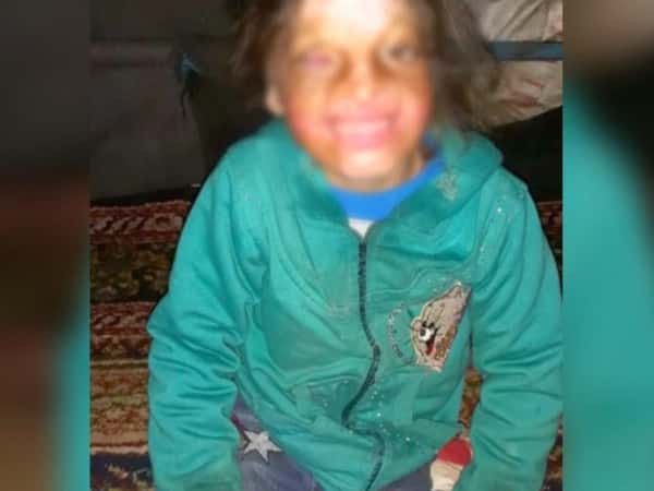 الطفلة إلهام وحروق وجهها