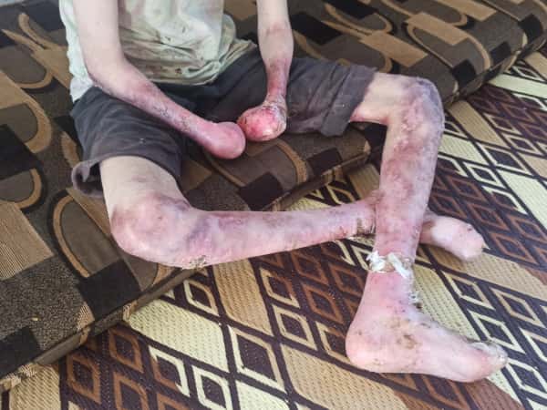 Mahmoud suffers from pemphigus vulgaris , needs your help