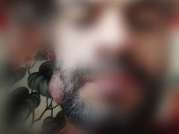 Ahmad is living in fear due to a mass in his cheek that requires resection and biopsy!