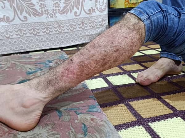 A skin disease poses a threat to Muhammad’s mental health.