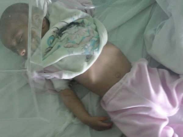 Open heart surgery for an infant
