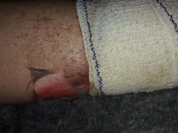 An elderly woman suffer gangrene