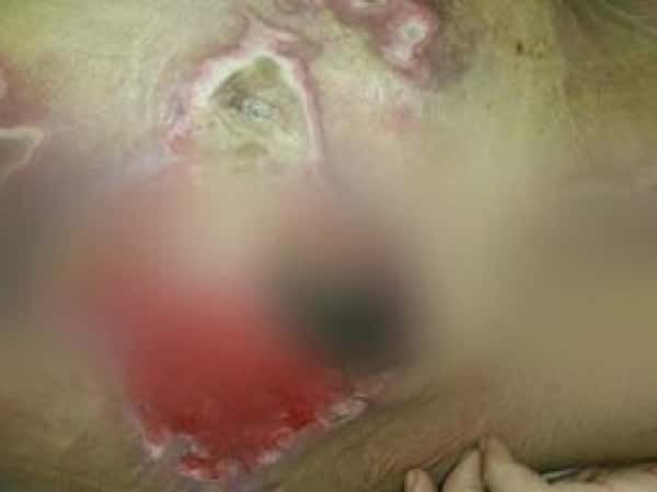 A refugee in need for treatment expenses