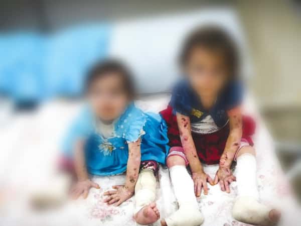 Two girls suffers from pemphigus