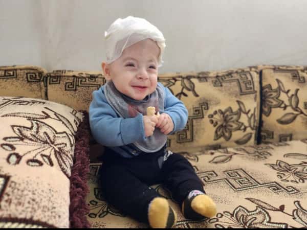 Omar is a baby who was suffers from craniosynostosis!