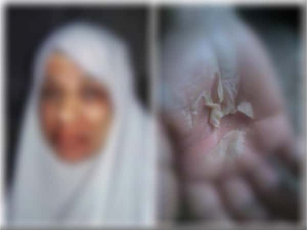a lady with thyroid cancer