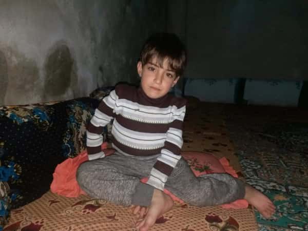 A girl suffering from a congenital deformity in the spine