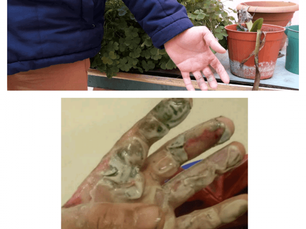 A family whose provider suffers from hand burns