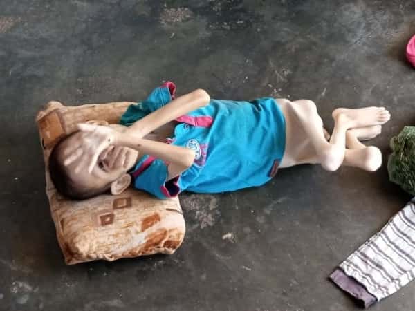 A child suffering from congenital cerebral palsy
