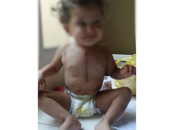 a girl with cardiac disorders
