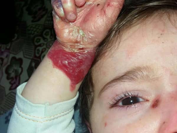 Two children suffering from hereditary pox disease