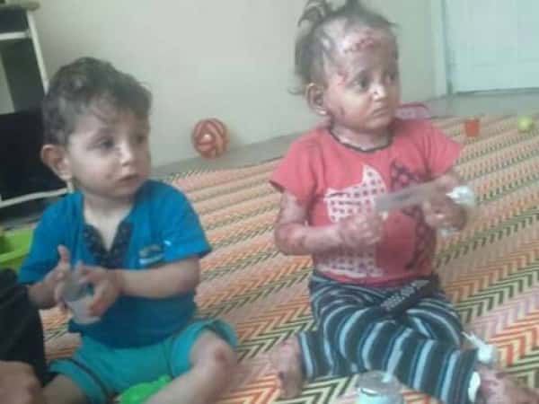 Treatment expenses for two siblings