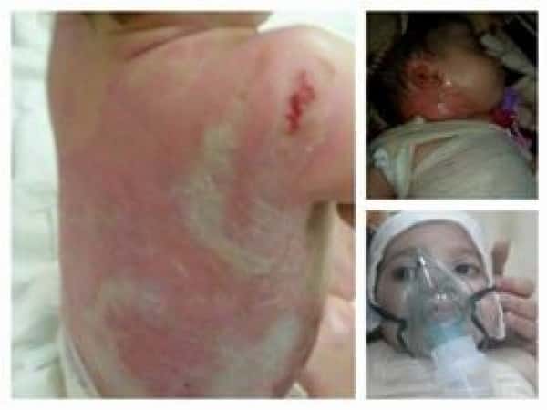 child suffering from burns