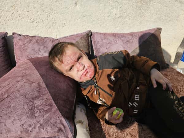 آثار المرض على وجهه