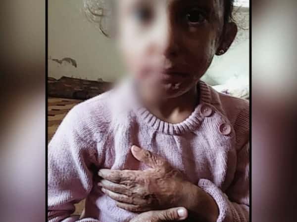 طفلة شوهتها صواريخ النابالم والفوسفور!
