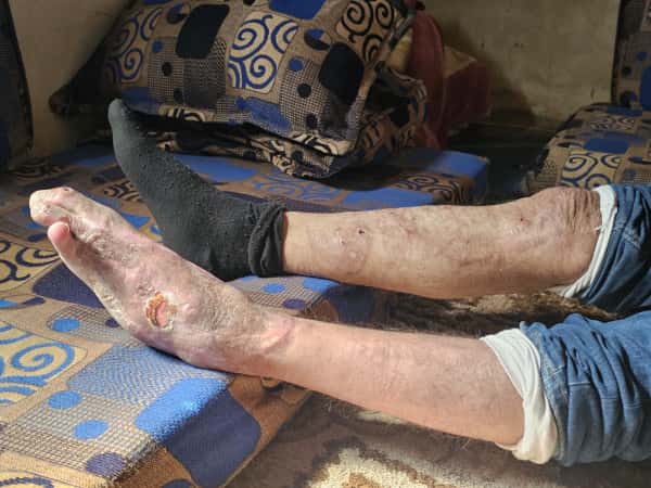 أيهم فقد عمله بعد إصابته