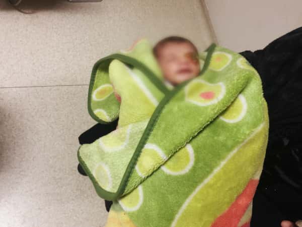 newly born child with cancerous mass in the eye
