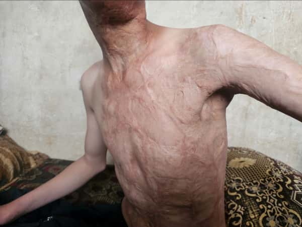 حروق تمنع أحمد من الخروج