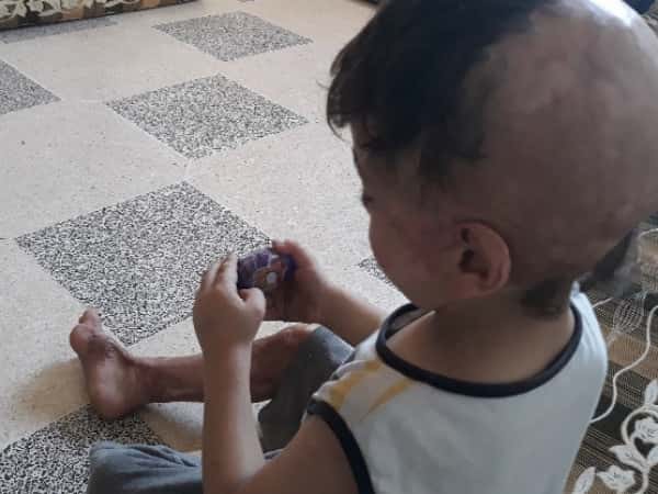 لم يكن صغر سنه شفيع له ألسنة اللهب التي شوهت جسده الهزيل