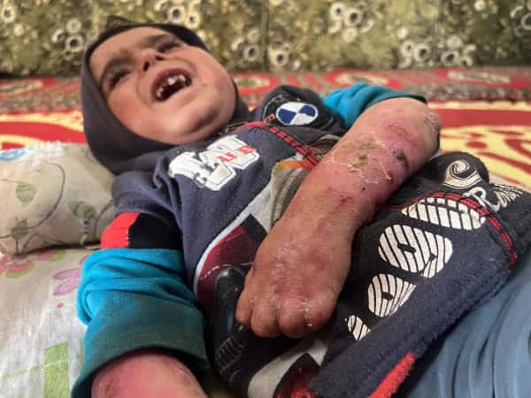 Hussein, leidet an Pemphigus und braucht Deine Patenschaft.