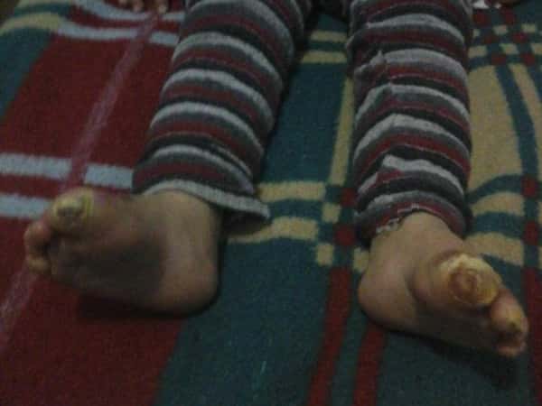 Child needing treatment expenses