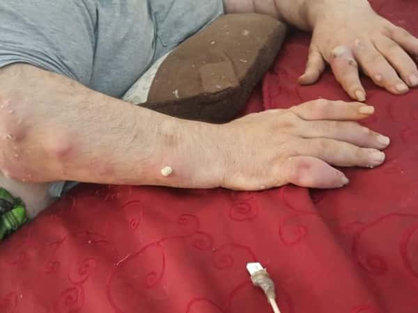 paralyzed patient needs treatment