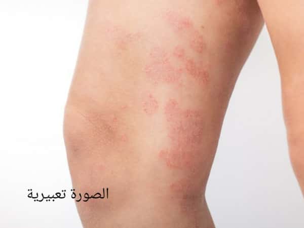A skin fungus spreads throughout Khadija’s body and takes away her rest!