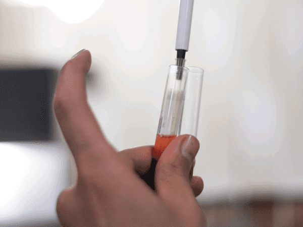 A woman with Albumin deficiency