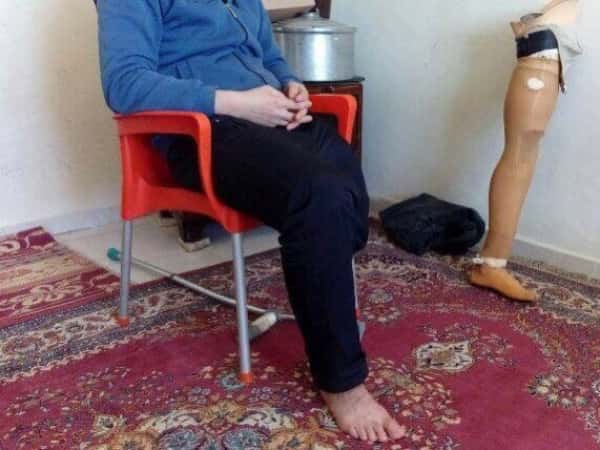 A young man, needs artificial limb