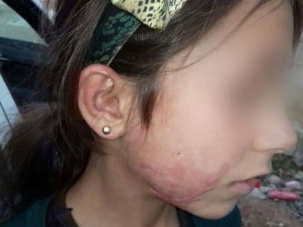 A little child suffers from burns