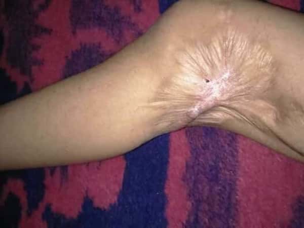 surgery is needed