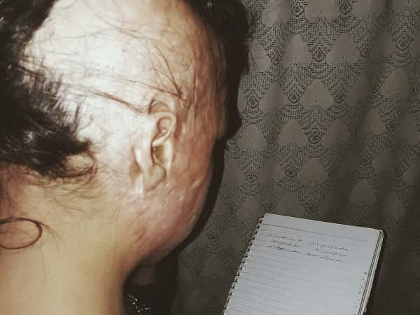 a little girl with severe burns!