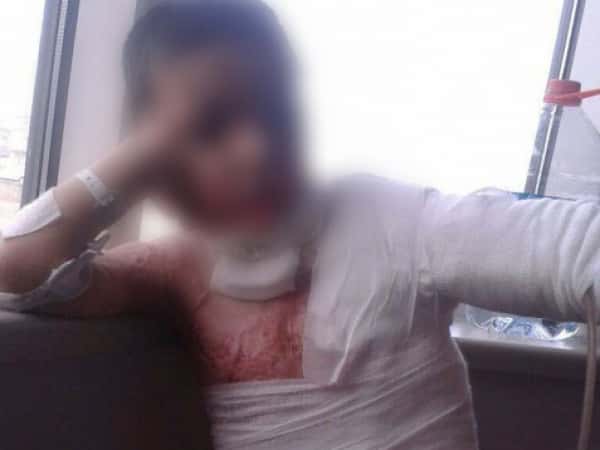A child suffering from severe burns