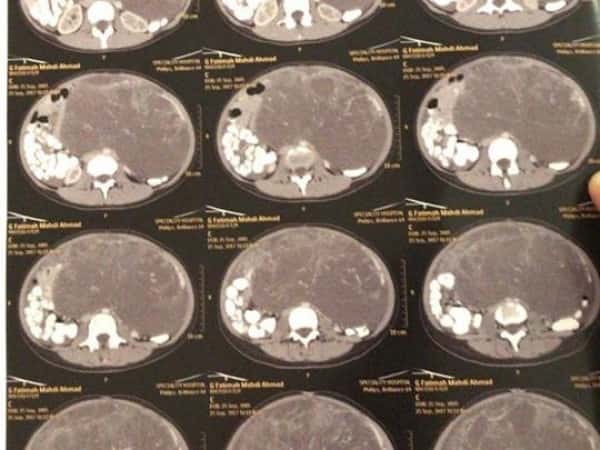 A child needs an abdomino-pelvic CT scan with contrast