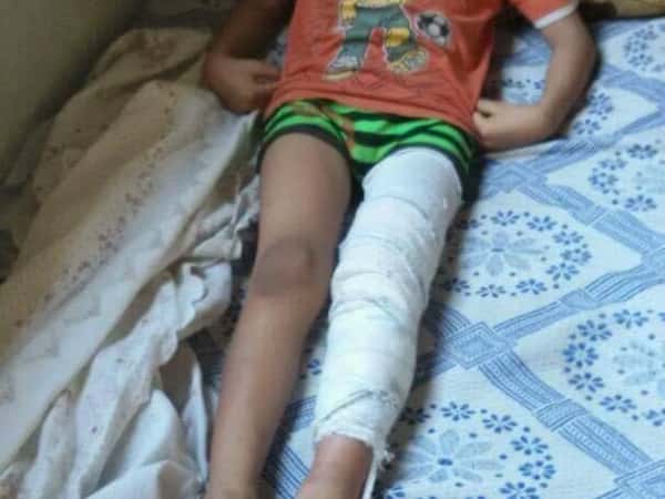 Treatment costs for a kid to walk again