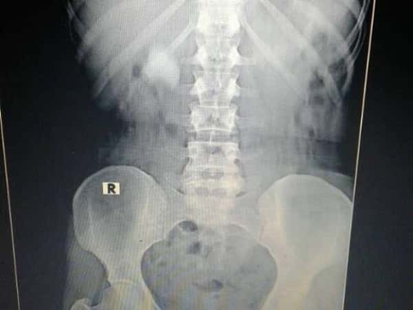 Intervention for renal stones