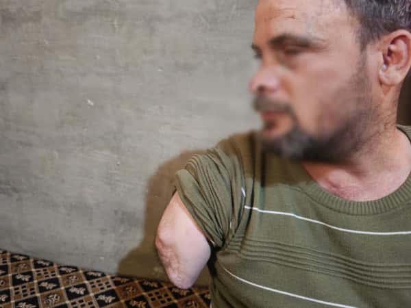 عبد الحسيب… يدٌ بُترت وحملٌ تضاعف