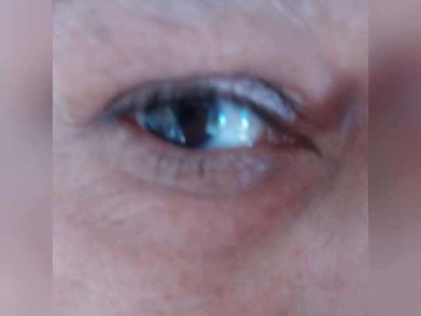 A patient in need for an eye surgery