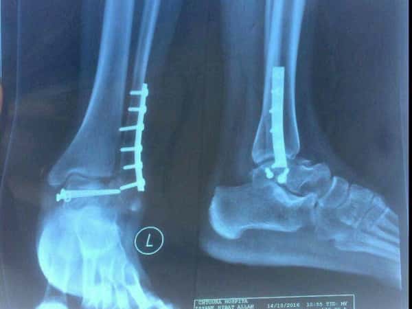 Young girl needing surgery expenses