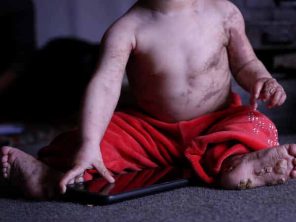 Seba suffers from a serious skin disease and needs your help