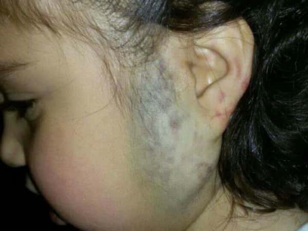 Treatment expenses for a little girl