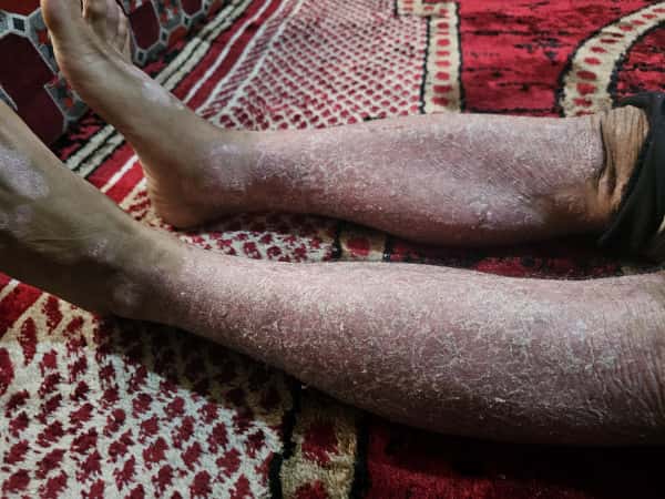 أحمد وعائلته مرضى بلا علاج