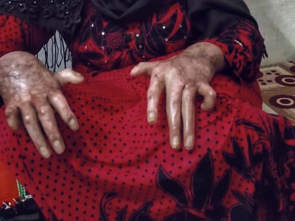 A woman had burns due to shelling